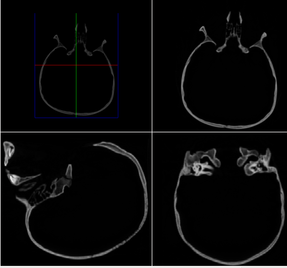 XZ and YZ reslices of a CT skull using nearest-neighbour interpolation. The bottom two panels show banding artefacts from the 2.44-voxel inter-slice spacing.