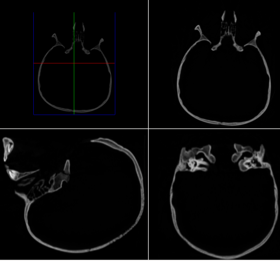 The same reslices with linear interpolation enabled. The banding is gone, at the cost of slightly softer edges.
